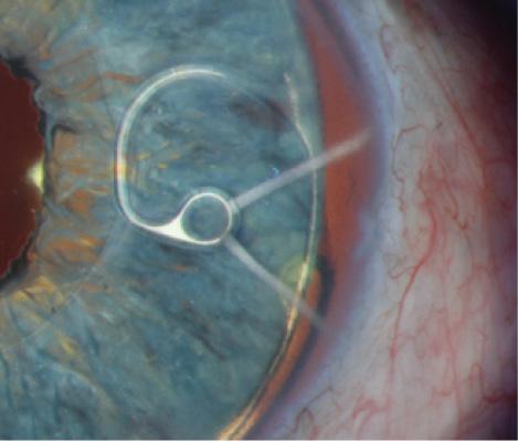 Figure 2. A slit-lamp photograph shows the fixation element of a Cionni Ring for Scleral Fixation in situ within the capsular bag in front of a customized iris prosthesis. The CTR and IOL haptic’s edge can be seen in the equator of the bag.