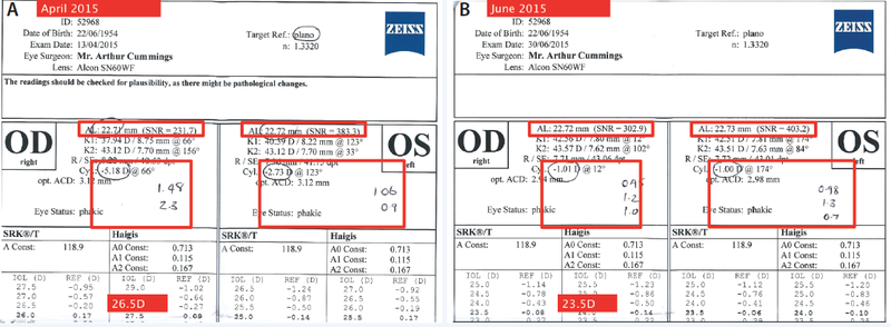Figure. Initial consultation with a patient who had DED and was being evaluated for a cataract. Preoperative measurements suggested an axial length of 22.72 mm OD and cylinder of -5.18 D at 66°, which would necessitate an IOL power of 26.50 D for a plano refractive target (A). During a subsequent evaluation after successful therapy for DED, axial length measured 22.71 mm OD with cylinder of -1.01 D at 12°, which would suggest an IOL of 23.50 D for a plano refractive target (B ). Additionally, the magnitude of astigmatism varied greatly in the dry eyes and was far more consistent and in agreement once the DED was treated. The other numbers written on this IOLMaster printout (Carl Zeiss Meditec) are the cylinder values from the Pentacam (Oculus Surgical) and the Lenstar (Haag-Streit).
