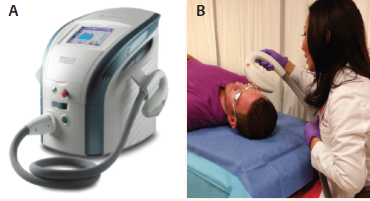 Figure 1. The Lumenis M22 IPL with OPT system (A) and a patient being treated for rosacea with the system (B).