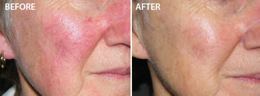Figure 2. Before and after photographs of a patient with moderate rosacea who was treated with the Lumenis M22 IPL with OPT system (four sessions, 1 month apart).
