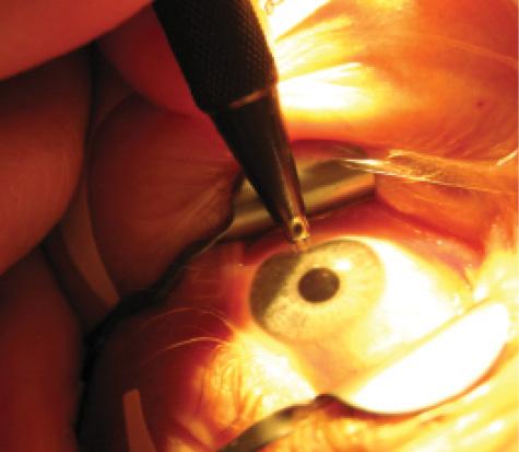 Figure 1. LRIs for preexisting astigmatism can be easily
performed in the OR.