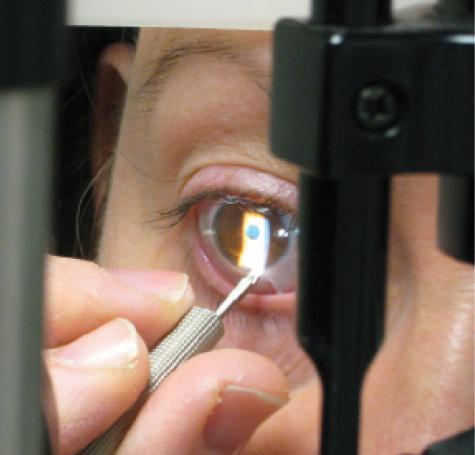 Figure 2. LRIs can be performed at the slit lamp in the office.