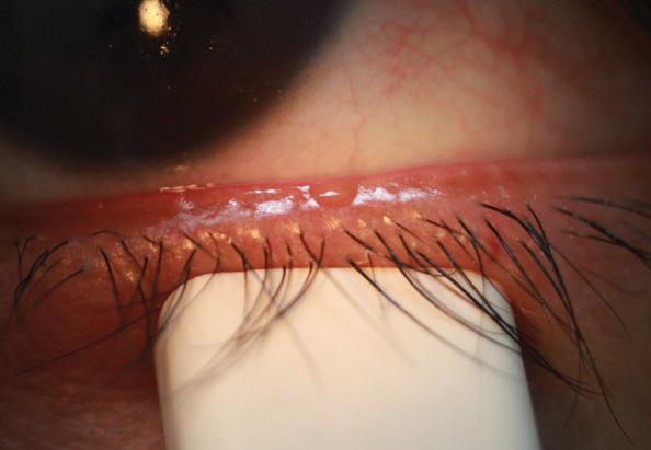 Figure 1. Eighty-six percent of all DED is attributed to MGD. The latter
may result in an unstable tear film, ocular surface disease, and
inflammation as well as bring about symptoms of irritation, burning,
and ocular fatigue.