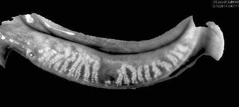 Figure 2. Dilation and truncation of the meibomian glands.
MGD is a chronic, prevalent, and progressive disease.
Visualizing gland structures makes the detection and
management of MGD easier.