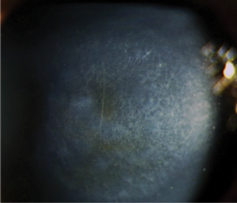 Figure 1. Corneal haze is mediated by activated keratocytes and is usually mild after CXL.