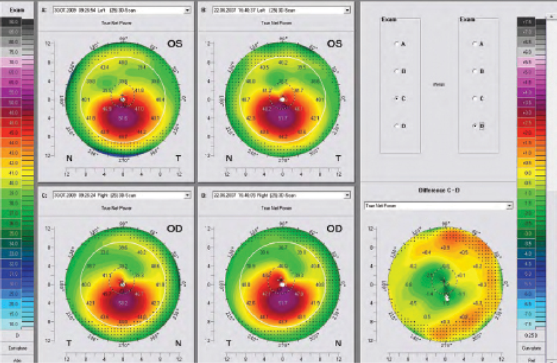 Figure 2. With roughly 2 years between pre- and postoperative maps, the difference map shows corneal flattening of 1.00 to 2.00 D following CXL.