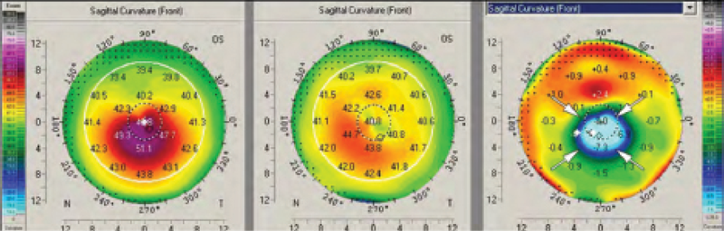 Figure 3. A massive corneal remodeling effect after CXL. A strong reduction in Kmax readings of up to 9.50 D can be observed in the difference map.
