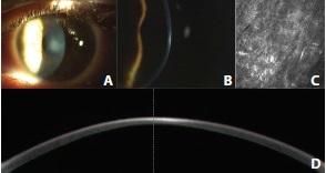 Figure 4. Slit-lamp photographs of central deep stromal haze in a patient’s left eye (A, B). Corneal confocal microscopic section of the anterior corneal stroma at 170 μm. The stroma shows activated keratocytes and hyperreflective deposits corresponding to subepithelial fibrosis (C). High-resolution Scheimpflug imaging of the corneal haze (D).