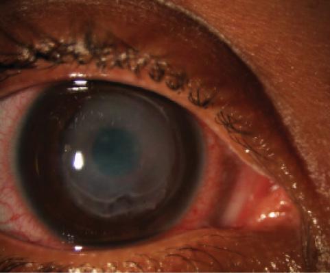 Figure 5. Corneal melt in a patient using excessive NSAID drops after CXL.