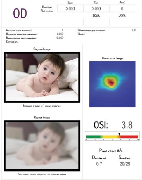 Figure 3. Abnormal OSI scan showing lenticular changes.