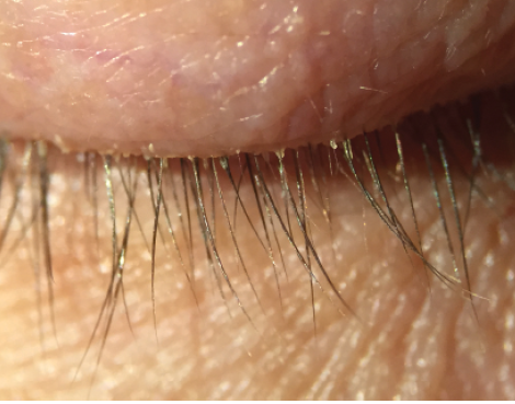 Figure 2. Many patients experience chronic inflammation and redness due to undiagnosed Demodex mites.