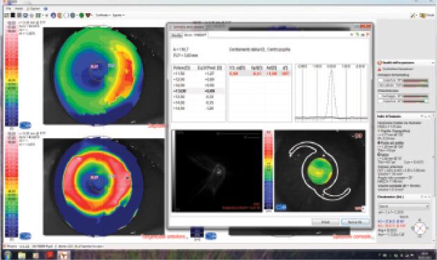 Figure. IOL power calculation by ray tracing with Sirius (Costruzione Strumenti
Oftalmici; not available in the United States) in an eye with previous myopic PRK
and a small, decentered optical zone. Preoperative refraction and corneal power are
unknown. The software suggests a 13.00 D IOL for emmetropia. A 14.00 D IOL was
implanted, with a final refraction of -0.50 D.