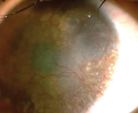 Figure 1. Preoperatively, the female sibling had obvious signs of GDLD, including the mulberry-like pattern opacities. (Note: all images are of the two siblings and not the first family members identified with GDLD.)
