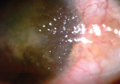 Figure 2. The male sibling also had obvious signs of GDLD, including the yellowish nodular lesions.