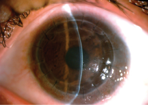 Figure 3. In postoperative month 3, the graft remains clear on the female sibling.