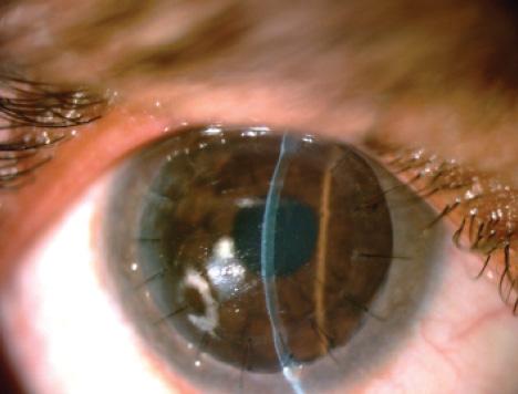Figure 4. Postoperatively at the slit lamp, the male sibling’s graft looks clear.
