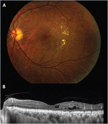 Figure 1. Fundus photograph (A) and enhanced depth imaging optical coherence tomography (OCT) scan (B) of a 59-year-old patient with DME. A report by the DRCR.net found that prior treatment for DME or preoperative DME increases the risk of center-involving DME postoperatively.7