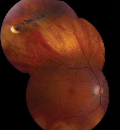 Figure 2. Lattice degeneration without associated retinal breaks in a 62-year-old patient. No level 1 evidence exists regarding the necessity of prophylactic laser retinopexy or cyrotherapy prior to cataract extraction for these lesions, and treatment should be individualized.