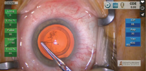Figure 2. Robert Cionni, MD, creating a CCC with the Verus.