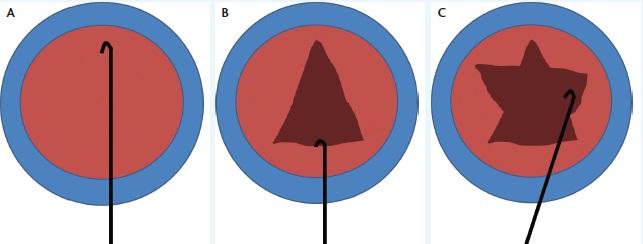 Figure 1. The can opener capsulotomy. The surgeon places a blunt cystotome on the distal anterior capsule and engages the anterior capsule, while being careful not to tear into it (A). By pulling on the anterior capsule with the blunt cystotome, the surgeon makes an ever-widening capsulotomy known as the Christmas tree (B). Additional relaxing incisions are made on either side to open the anterior capsule enough to eliminate any impediment to prolapsing the nucleus (C).