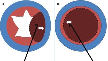 Figure 2. To prolapse the nucleus, the surgeon rocks it more than halfway across the eye, while watching as the equator of the lens crosses the midline of the pupil (A). As the nucleus rocks back, the cystotome releases pressure and coaxes the nucleus into the anterior chamber for emulsification. This was before viscoelastics were used (B).