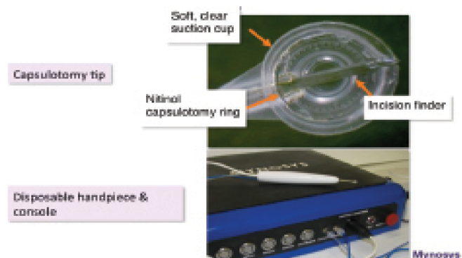 Figure 1. The Zepto capsulotomy system is composed of a clear suction cup, nitinol capsulotomy ring, incision finder, disposable handpiece, and power console.
