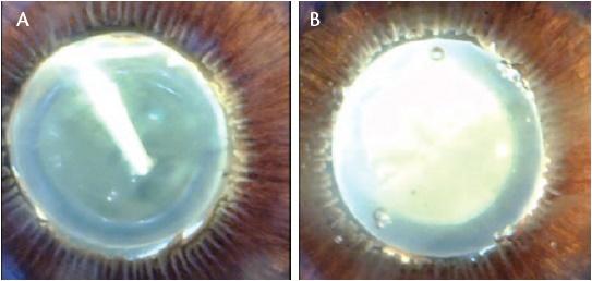 Figure 3. Zonular safety in manual capsulorrhexis (A) and Zepto capsulotomy (B).