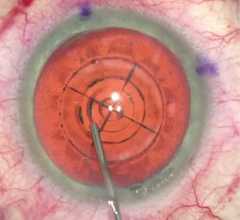 Figure 1. The femtosecond laser can create cylinders with a diameter set by the surgeon. The chop pattern often extends beyond the cylinder cuts and even beyond the capsulotomy. This cylinder size will have an impact on nuclear removal.