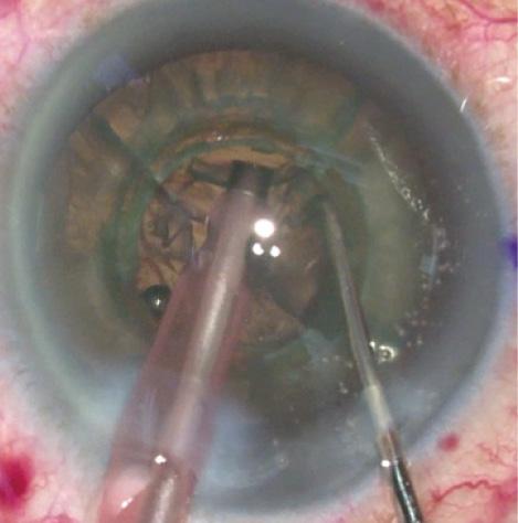 Figure 2. The densest part of the lens was easily removed using four cylinders, with the largest cylinder 4.7 mm, and a chop pattern of 5.3 mm. This bowled-out area created a workspace for the remaining four quadrants to stay in the capsular bag, away from the cornea, during the remaining nuclear removal.