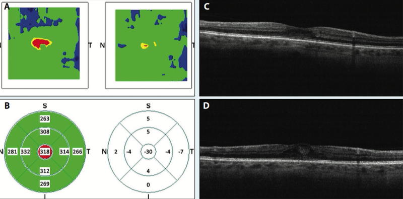 Figure. Optical coherence tomography (OCT) images of a 67-year-old woman with a 16-year history of well-controlled diabetes and mild blur in both eyes. Her left eye was 20/50 at presentation. She was unwilling to try injectable therapies, so primary micropulse laser treatment was applied. These OCT images represent her progress at 2 months after laser therapy. Color topography of central foveal edema improvement (A). Mathematical model calculation of central foveal thickness improvement (C). Spectral-domain OCT pretreatment foveal edema (C). Spectral-domain OCT posttreatment foveal edema improvement (D).