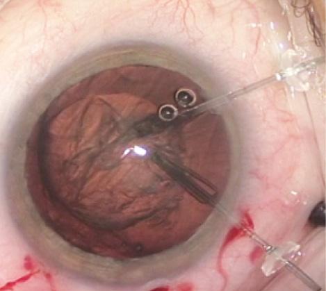 Figure 1. The looped ends of two capsule retractors (MicroSurgical Technology) support the equator of the capsular bag rather than the capsulorhexis margin. These hooks are larger than iris retractors, though, and thus consume more of the central working space than iris hooks, which “tent” the CCC margin.