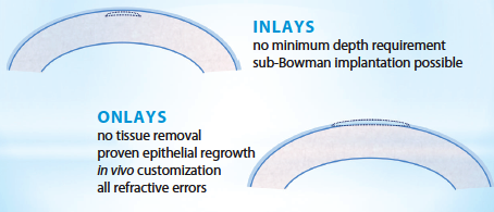 Figure 1. Benefits of allogenic inlays and onlays.