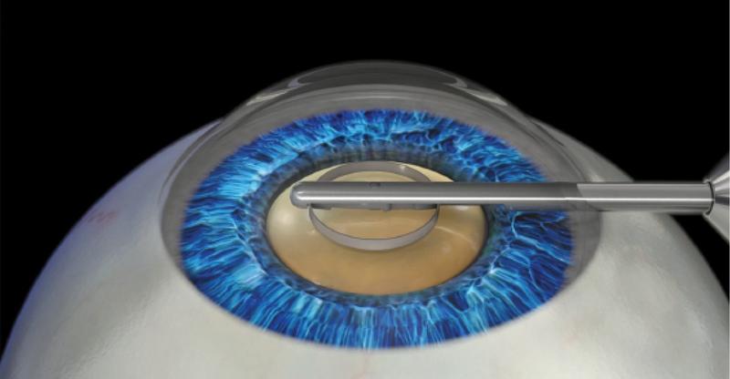 Figure. The 360° ring extends from an ergonomic handpiece and allows uniform contact with the anterior capsule.
