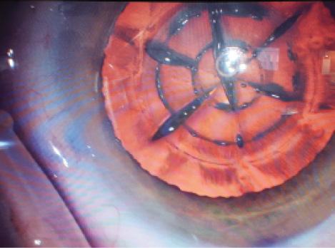 Figure 2. Type 3 laser capsulotomy in a patient with a history of prior radial keratotomy. One discontinuity is visible at 4 o’clock, a second at 6 o’clock, and a third at 7 o’clock.