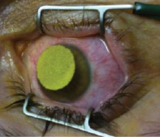 Figure 1. A corneal protector sponge is soaked with riboflavin to help with riboflavin loading during epi-on CXL.