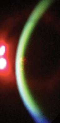 Figure 2. A slit-lamp view confirms sufficient riboflavin in the cornea to proceed with UV light therapy for epi-on CXL.