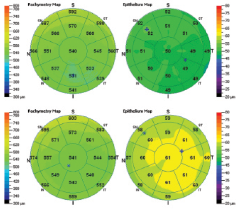 Figure 1. Representative corneal total thickness maps (left) and corneal epithelium thickness maps (right) of a normal patient from group A (top) and a dry eye patient from group B (bottom), as provided by the AS-OCT system report.