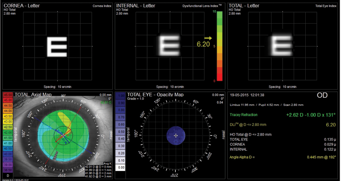 Figure 1. The iTrace dysfunctional lens display demonstrates the contributions of cornea and crystalline lens and total eye vision simulation using Snellen E. This display also illustrates the dysfunctional lens index score on a color scale.