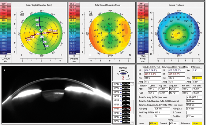 Figure 2. The Pentacam cataract preoperative display.