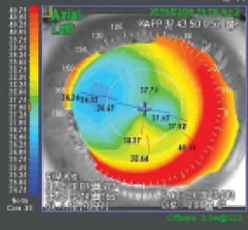 Figure 1. Corneal topography after the primary SMILE procedure.