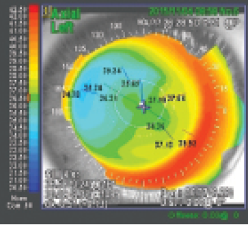 Figure 2. Corneal topography 6 months after enhancement with sub-cap LE.