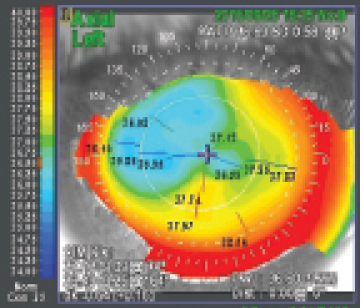 Figure 4. Corneal topography 6 months after enhancement with sub-cap LE.
