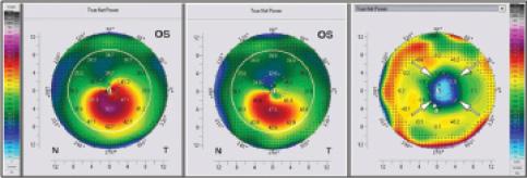 Figure 2. Example of massive flattening following CXL. Scheimpflug analysis of the anterior corneal surface (true net power) before (A) and at 12 months after (B) CXL. The difference image (C) shows a strong reduction of maximum keratometry values of up to 9.00 D.