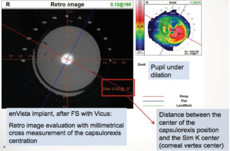 Figure 1. Evaluation of alignment and of capsulotomy centration.