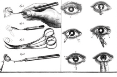 Figure 1. Daviel’s capsulotomy technique involved an inferior incision in the eye.