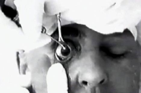 Figure 2. Ignacio Barraquer removing a cataract with the erisophake technique.