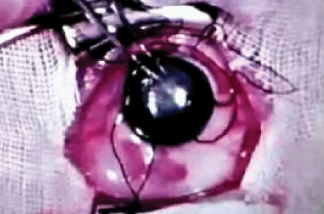 Figure 3. Sir Harold Ridley performing a forceps capsulotomy.