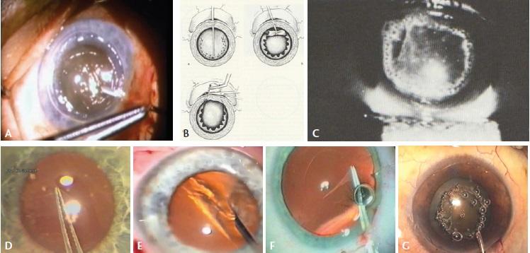 Figure 4. Charles D. Kelman, MD, performing a Christmas tree capsulotomy (A); can-opener capsulotomy (B); Nd:YAG laser anterior capsulotomy (C); Albert Galand completing a capsulotomy with the envelope technique (D); Calvin K. Fercho, MD, performing a circular capsulotomy (E); the author performing a posterior CCC (F); Kloti high-frequency radio diathermy capsulotomy (G).