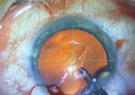 Figure 6. Heads-up display on the Verion for capsulotomy.