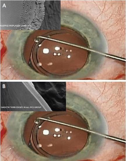 Figure 7. Scanning electron microscopy (SEM) of femtosecond capsulotomy edge (A); SEM of manual capsulotomy edge (B).